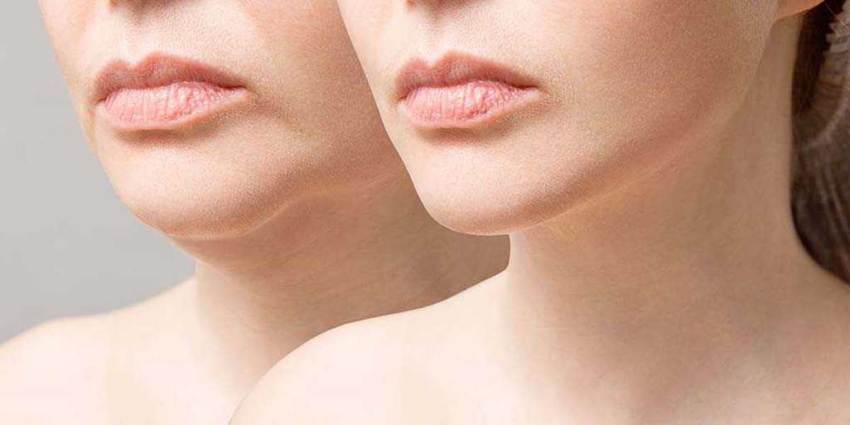 Say Goodbye to Wrinkles: The Power of Dermal Fillers for Smoother Skin