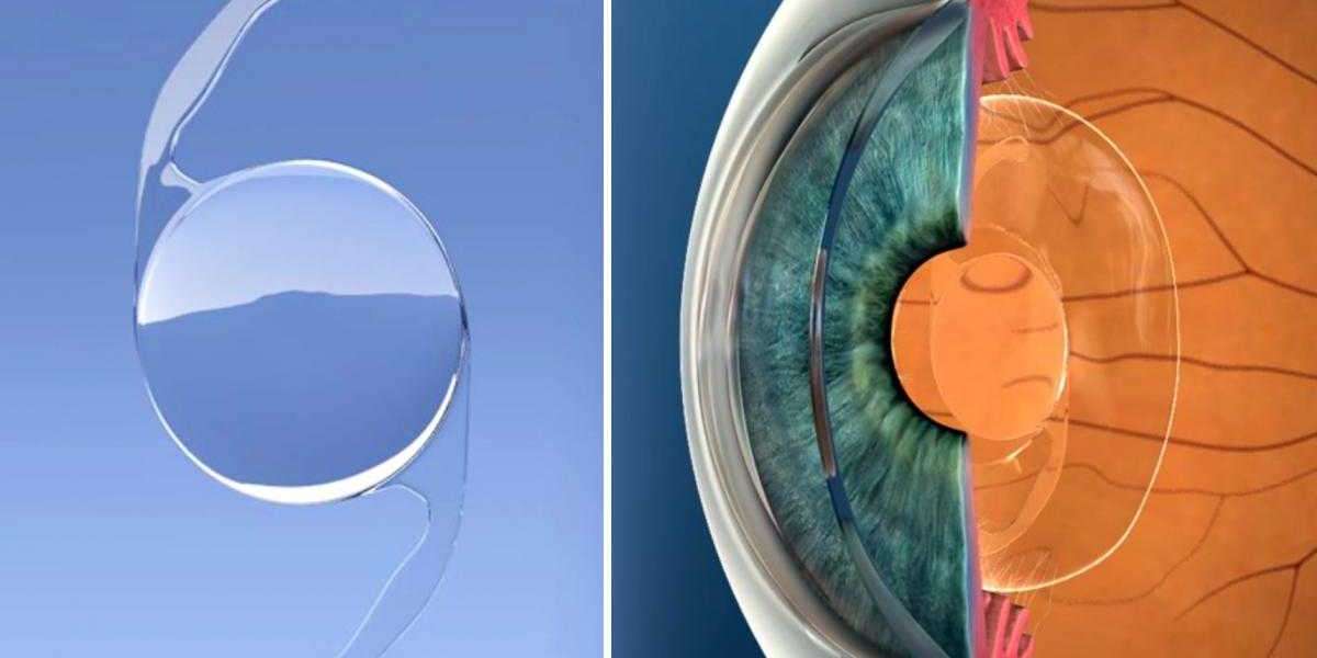 Global Intraocular Lens Market Share & Upcoming Industry Growth
