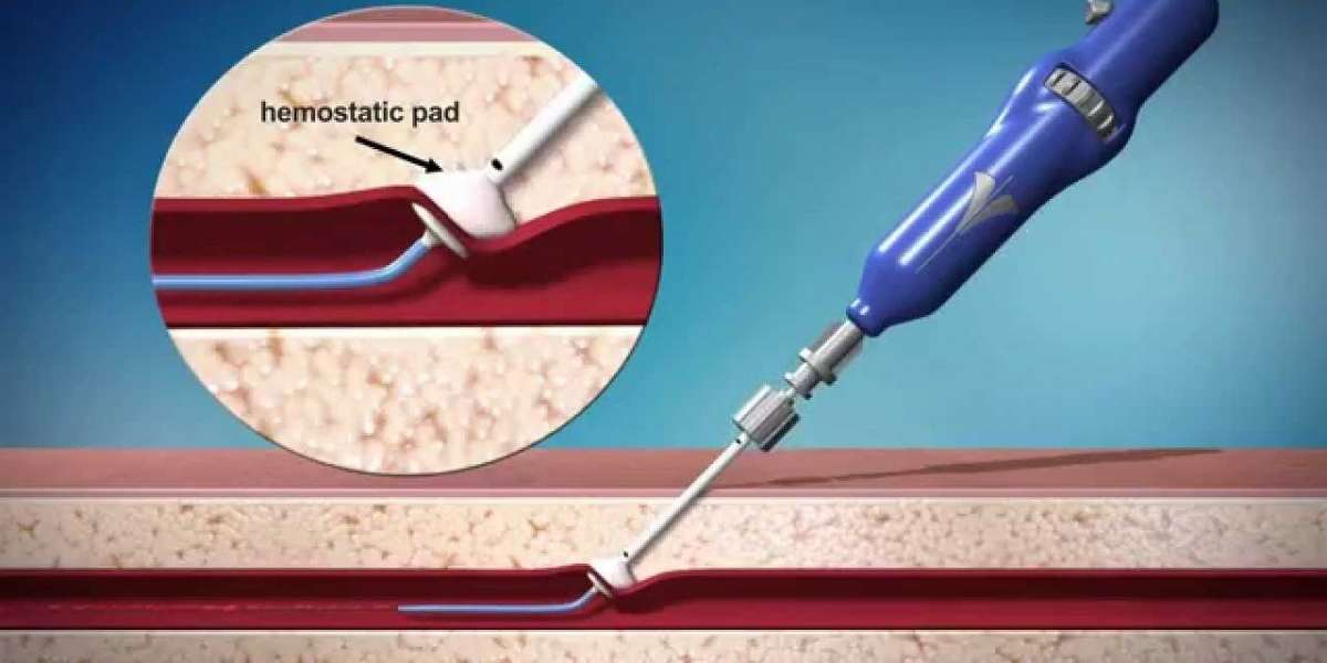 Global Vascular Closure Devices Market Analyzed in New Market Report