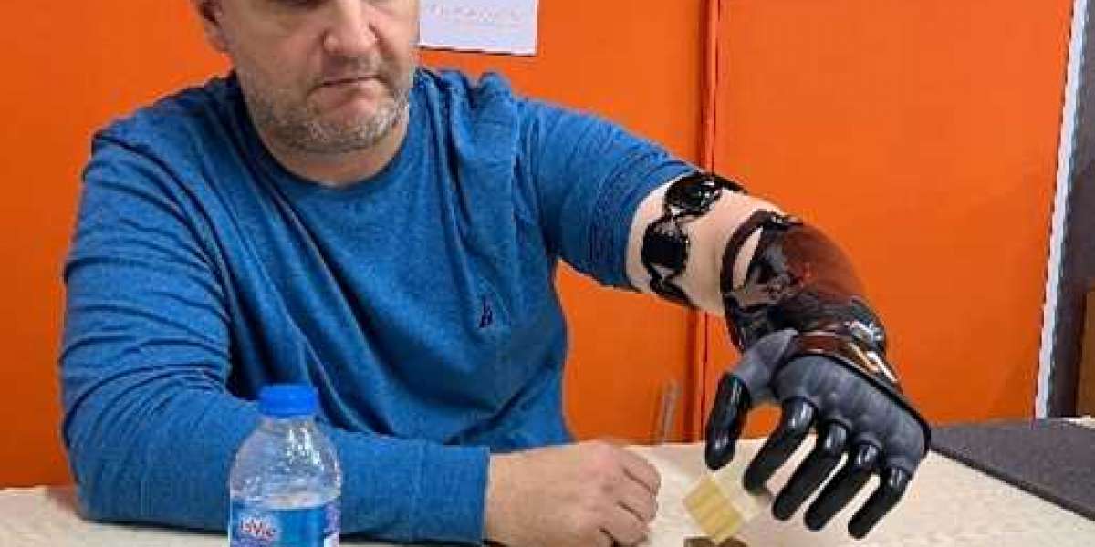 Decoding Prosthetic Hand Cost in India: A Comprehensive Guide