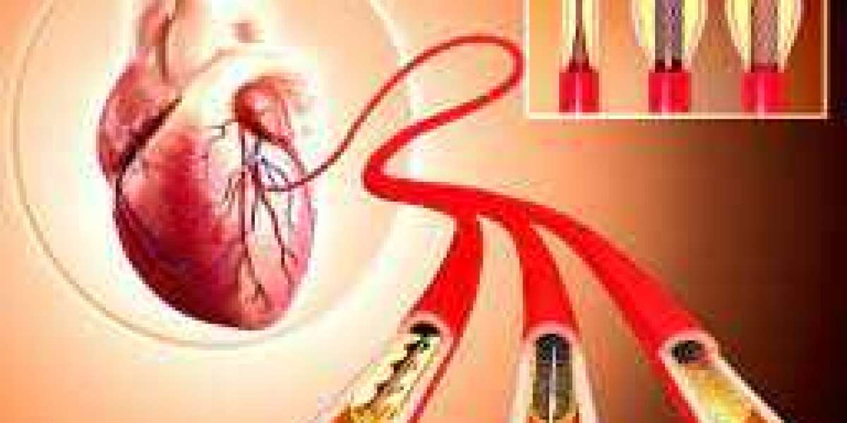 Advancing Cardiac Care: Complex Angioplasty Expertise Thrives in Jaipur