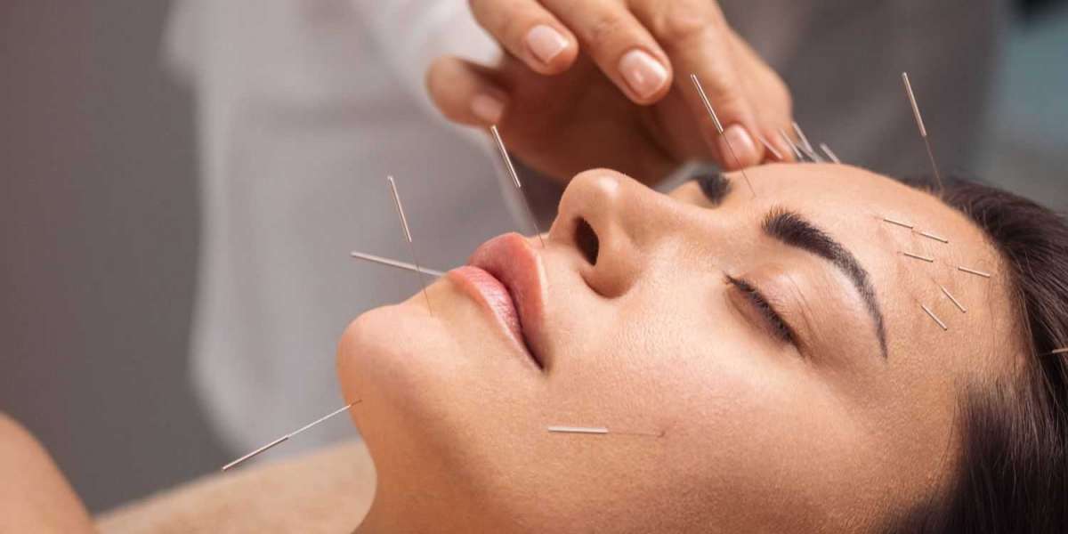 The Ultimate Guide to Acupuncture: Everything You Need to Know