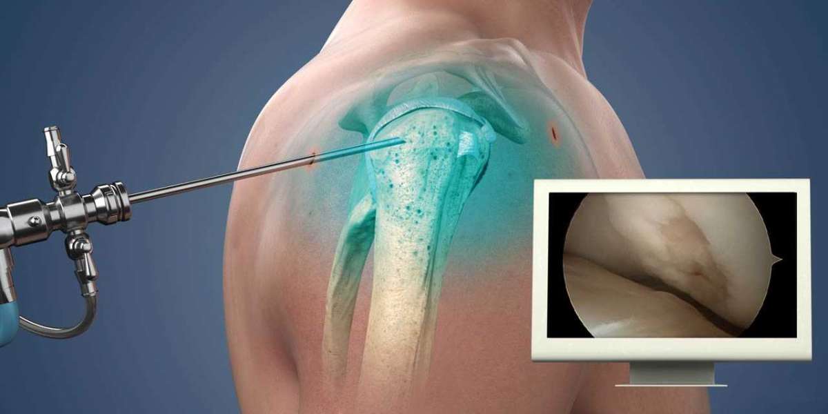 Exploring Precision and Recovery: Shoulder Arthroscopy