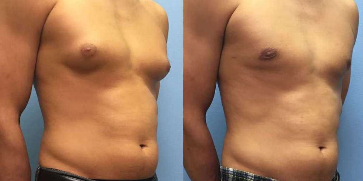 Expert Male Breast Surgery in Pune - Dr. Shilpy Dolas