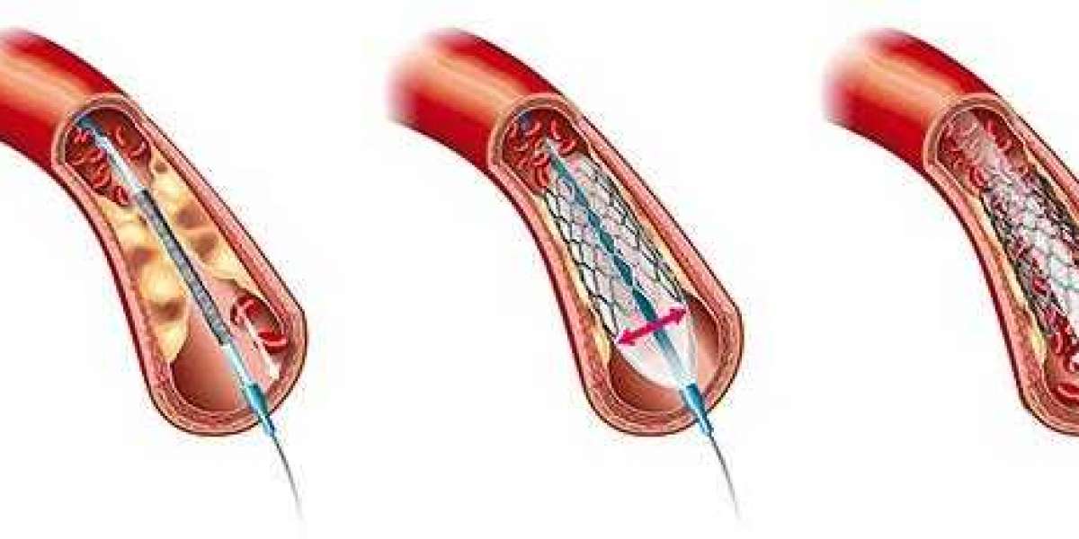 Revitalizing Mobility: The Best Peripheral Angioplasty in Jaipur