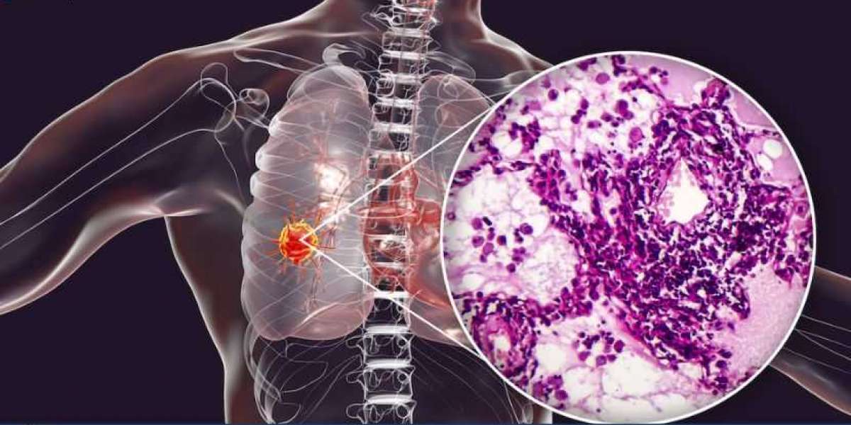Cancer Therapeutics Market Size, Share, Trends, Outlook, Growth, Analysis, Report and Forecast 2024-2032