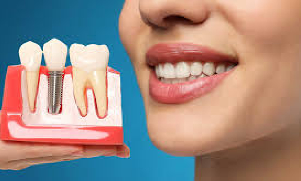 Choosing Top Dental Implants: The Smartest Investment in Your Oral Health