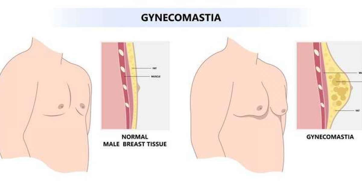 Minimally Invasive Options on the Rise: The Changing Landscape of Gynecomastia Treatment