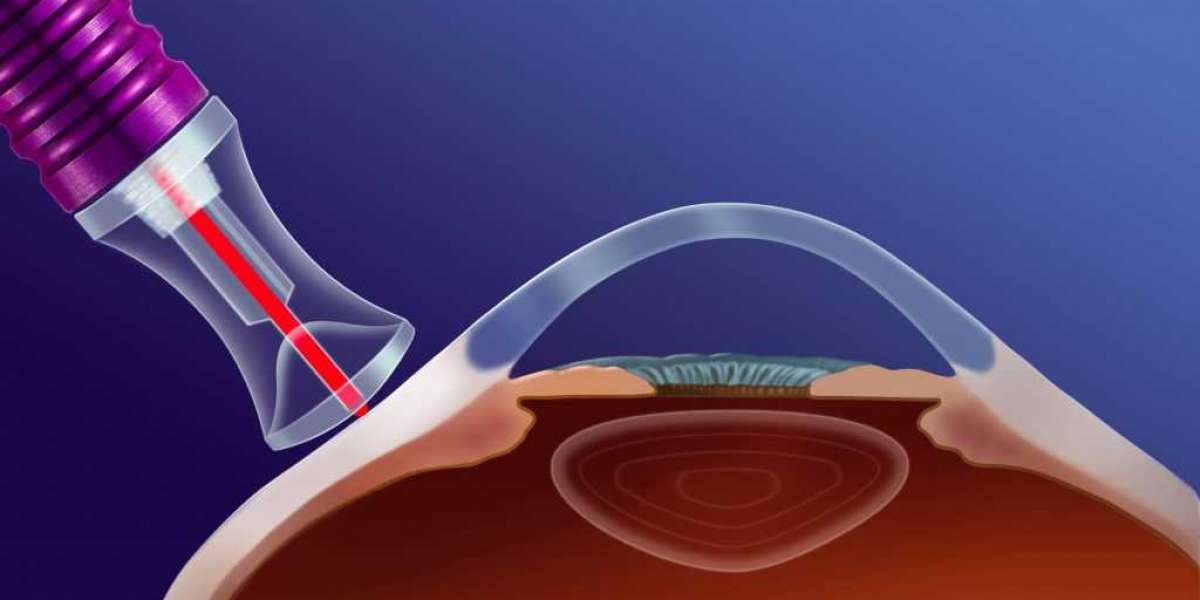 Laser vs. Traditional Glaucoma Surgery: A Patient's Guide & Recovery