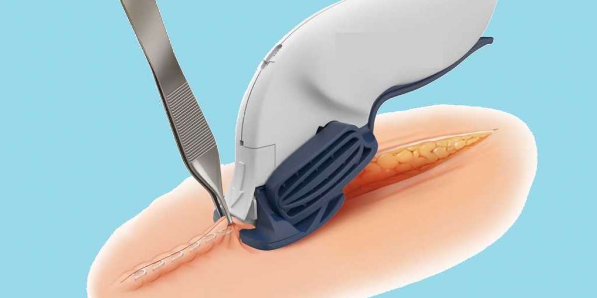 Minimally Invasive, Faster Recovery: Surgical Staplers Revolutionize Surgery