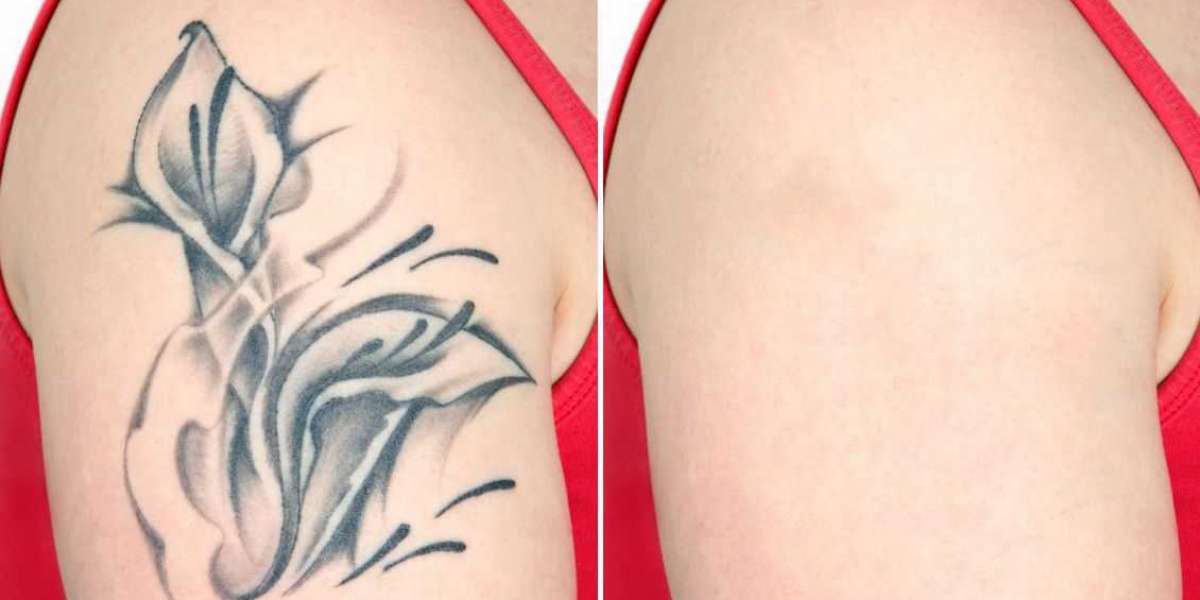 Tattoo Removal Market Booms to $17.65 Billion: Lasers Lead the Charge