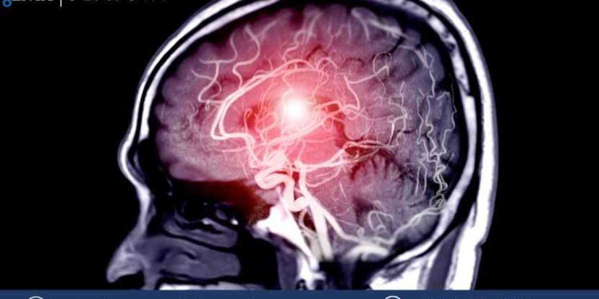 North America Intracranial Aneurysm Market Size, Share, Trends, Growth, Industry Analysis & Report | 2032